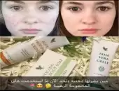 مجموعة حب الشباب 